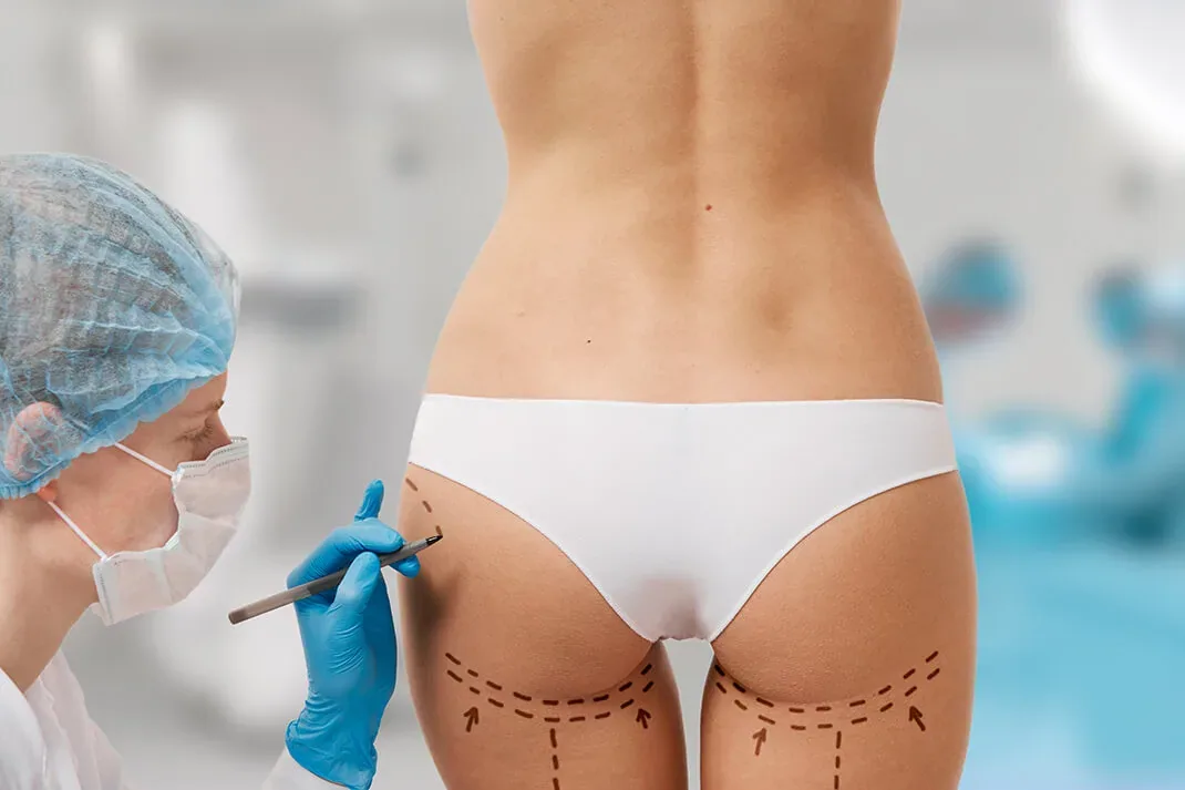 What You Must Know Before Choosing a BBL Procedure for Your Dream Shape