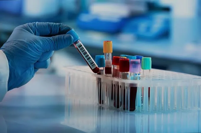 Complete Blood Count (CBC): The Silent Guardian of Your Health