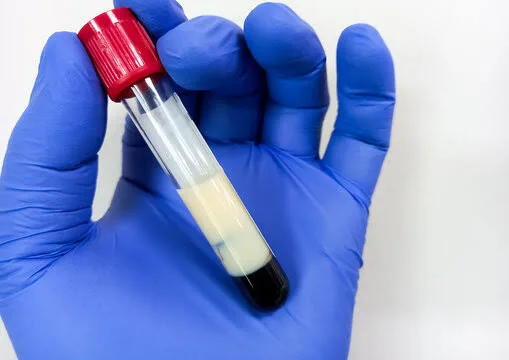 Lipid Panel (Cholesterol Test): What Your Numbers Really Mean