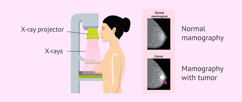 Mammograms: The Scan That Could Save Your Life