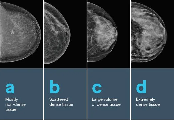 Frequently Asked Questions About Mammograms