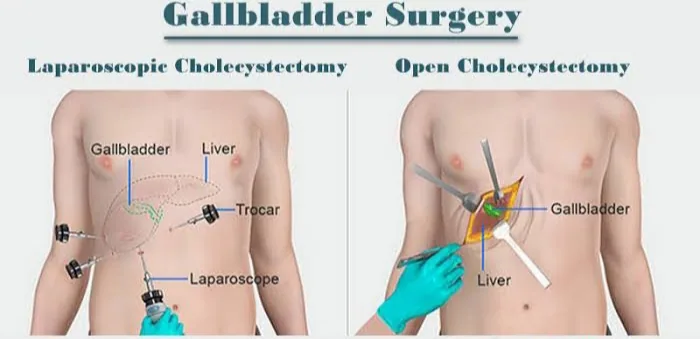 Gallbladder Removal (Cholecystectomy): Treating Gallstones and Gallbladder Disease