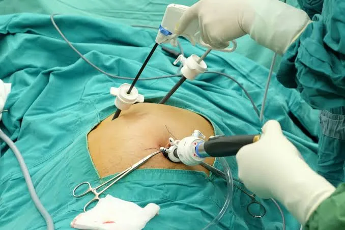 Gallbladder Removal (Cholecystectomy): Treating Gallstones and Gallbladder Disease