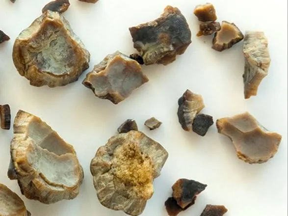 Gallbladder Removal (Cholecystectomy): Treating Gallstones and Gallbladder Disease