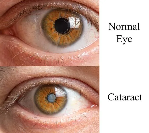 Cataract Surgery: See the World Clearly Again