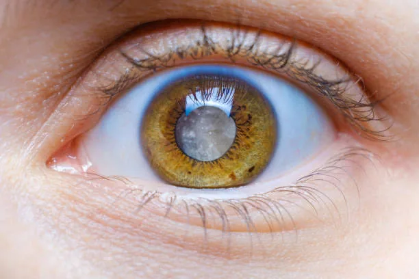 Cataract Surgery: See the World Clearly Again