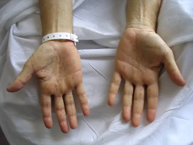 Rising Cases of Syphilis: Understanding the Risks, Symptoms, and Effective Treatment