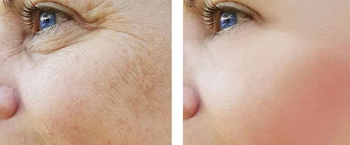 Facelifts vs Mini Facelifts: What’s Right for Your Skin and Age?