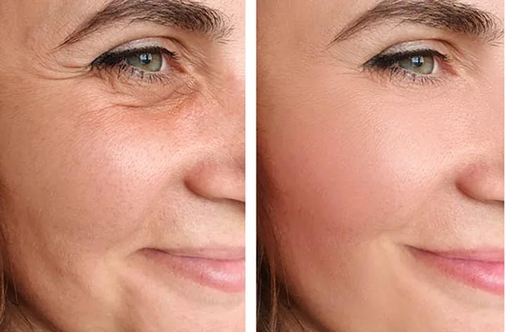 Facelifts vs Mini Facelifts: What’s Right for Your Skin and Age?