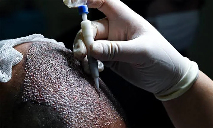 Beard Transplants Explained: The Permanent Solution to a Thicker Beard