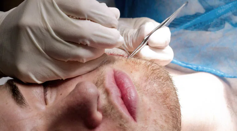Beard Transplants Explained: The Permanent Solution to a Thicker Beard