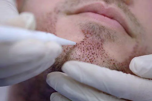 Beard Transplants Explained: The Permanent Solution to a Thicker Beard