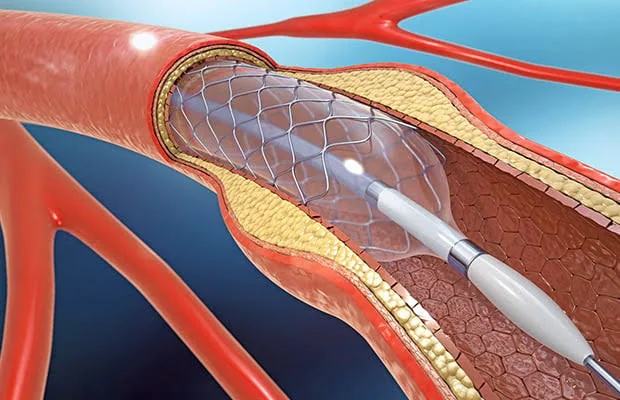 Why Medications Can’t Clear a 90% Blocked Artery and When You Need a Stent