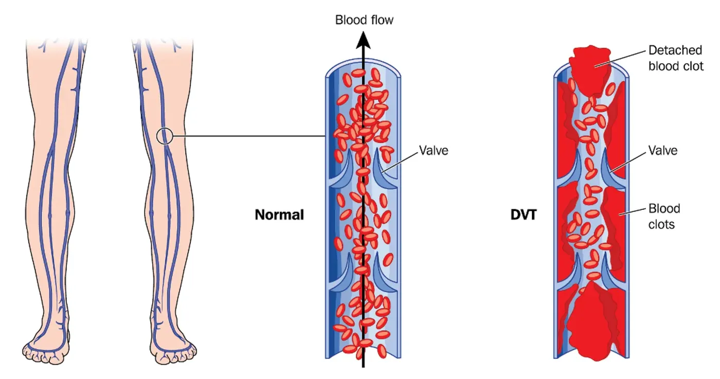Why Prolonged Sitting Is As Dangerous As Smoking for Your Health