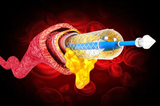 Mastering Stents: A Comprehensive Guide to Types, Placement, and Medical Applications