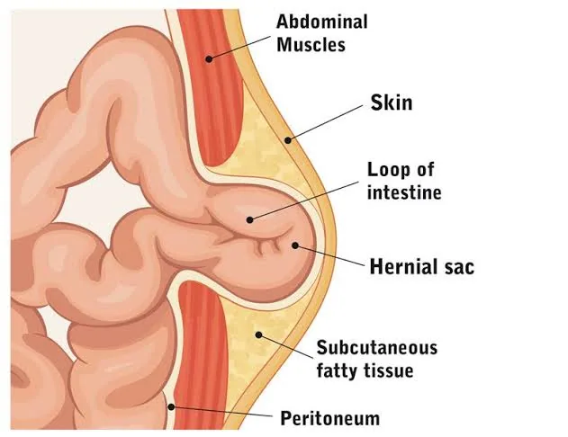 Common Mistakes People Make That Allow a Small Hernia to Grow Rapidly