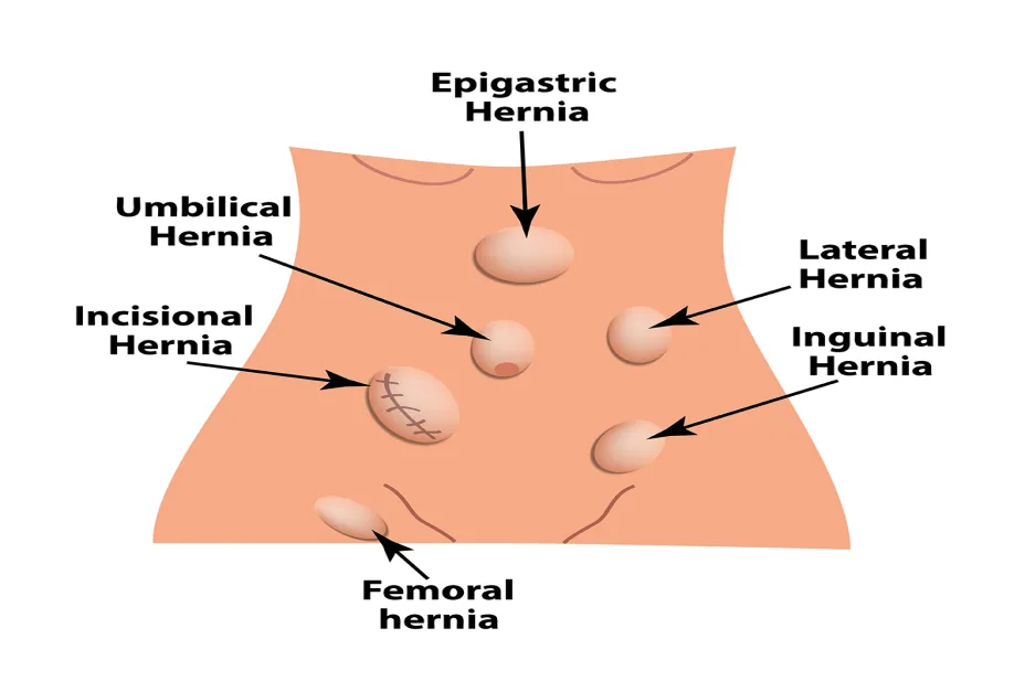 Common Mistakes People Make That Allow a Small Hernia to Grow Rapidly