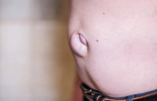 Common Mistakes People Make That Allow a Small Hernia to Grow Rapidly