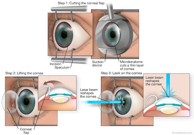 Discover How LASIK Surgery Reshapes Your Eyes for Sharper Vision and Lasting Clarity