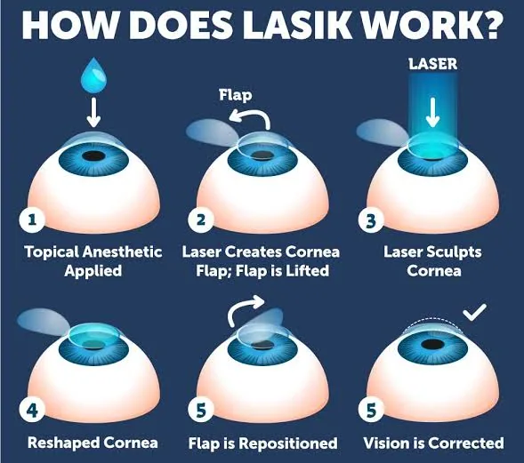 Discover How LASIK Surgery Reshapes Your Eyes for Sharper Vision and Lasting Clarity