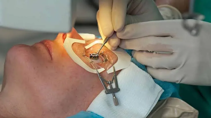 Discover How LASIK Surgery Reshapes Your Eyes for Sharper Vision and Lasting Clarity