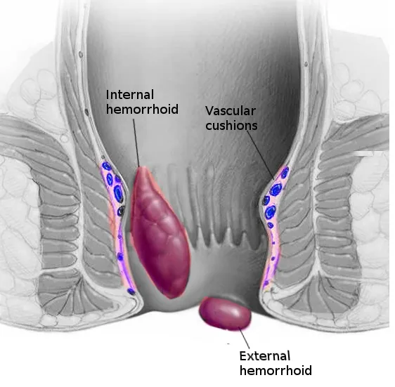 The Hidden Signs Of Hemorrhoids That Most People Fail To Notice