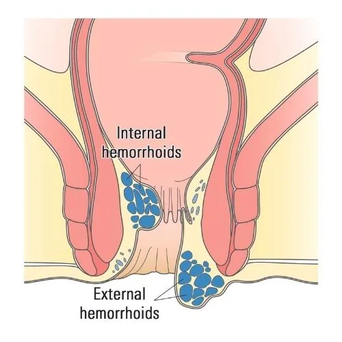 The Hidden Signs Of Hemorrhoids That Most People Fail To Notice