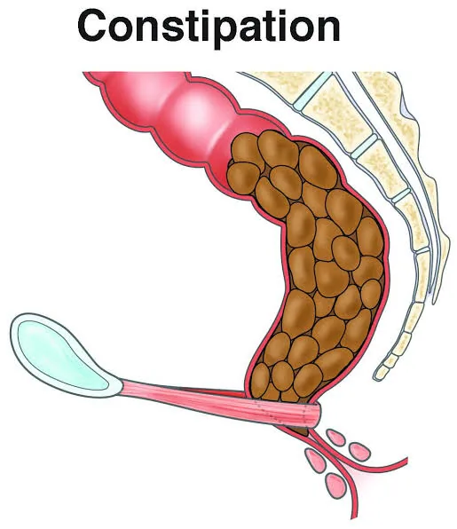 The Surprising Link Between Constipation And The Silent Growth Of Hemorrhoids