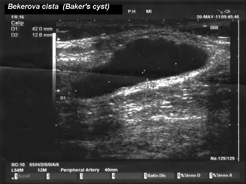 Longitudinal ultrasonographic image of a Baker cyst (42,0 x 12,8 mm)