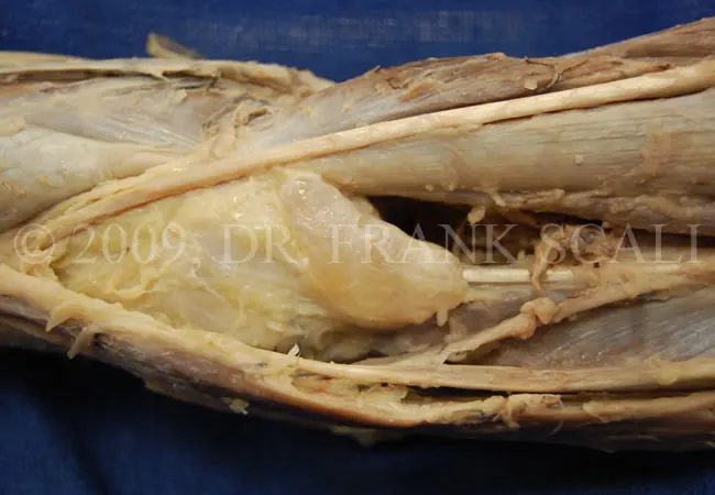 A Baker's cyst (popliteal cyst) is located behind the knee and is a swelling of the popliteal bursa