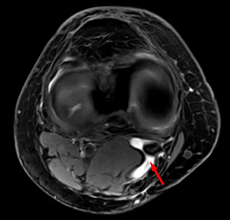 Baker's cyst on axial MRI with communicating channel between the semimebranosus muscle and the medial head of the gastrocnemius muscle