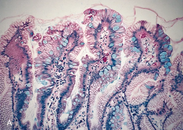 ESOPHAGUS-STOMACH: MUCIN STAINS OF BARRETT'S MUCOSA Alcian blue stain of Barrett's mucosa shows the blue-staining goblet cells, a few specialized columnar cells, and the clear-staining gastr