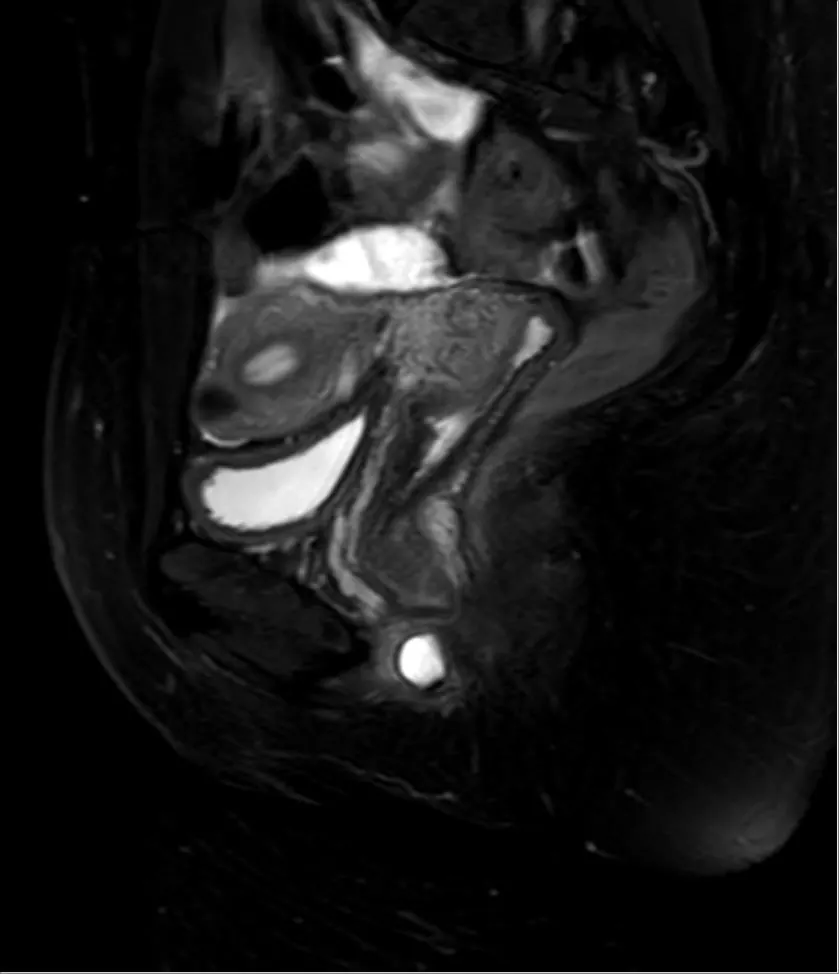 Bartholin-Zyste 42W - MR SPAIR sagittal