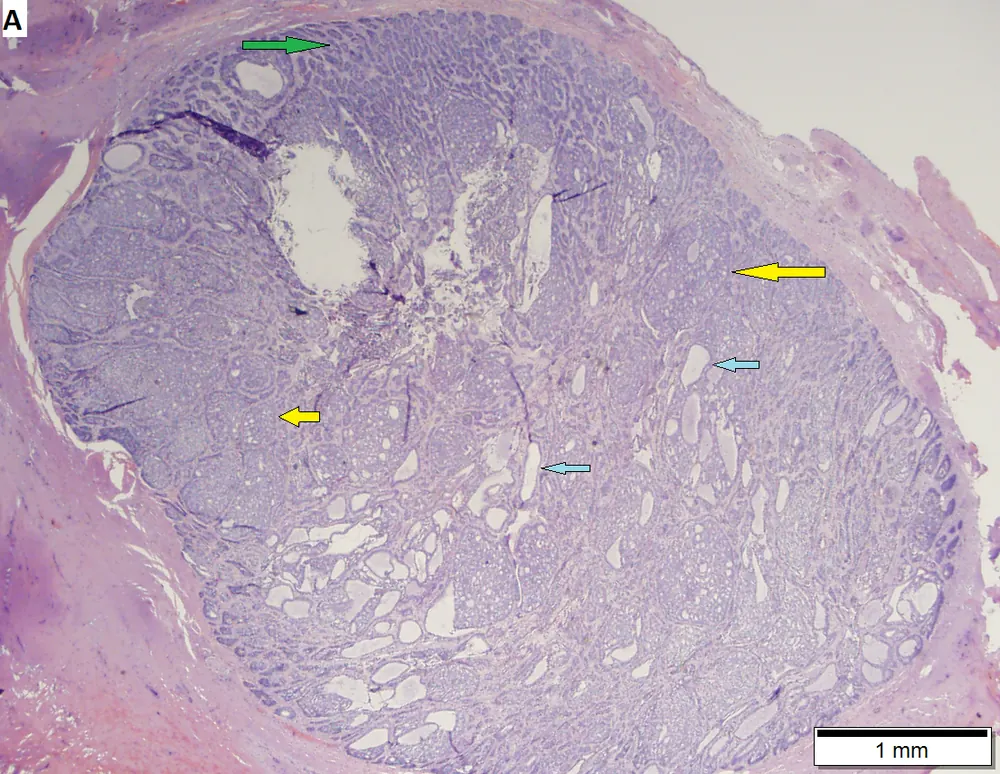 Basal cell carcinoma with mucin production