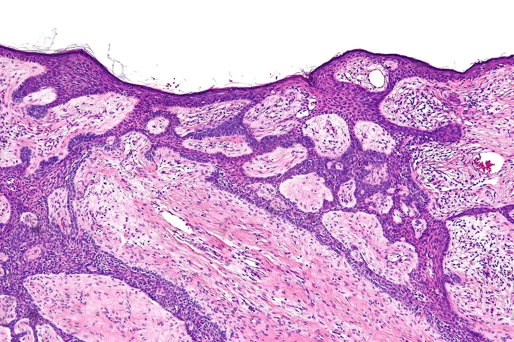 Intermediate magnification micrograph of basal cell carcinoma fibroepitheliomatous pattern , also known as fibroepithelioma of Pinkus and fibroepitheliomatous basal cell carcinoma 