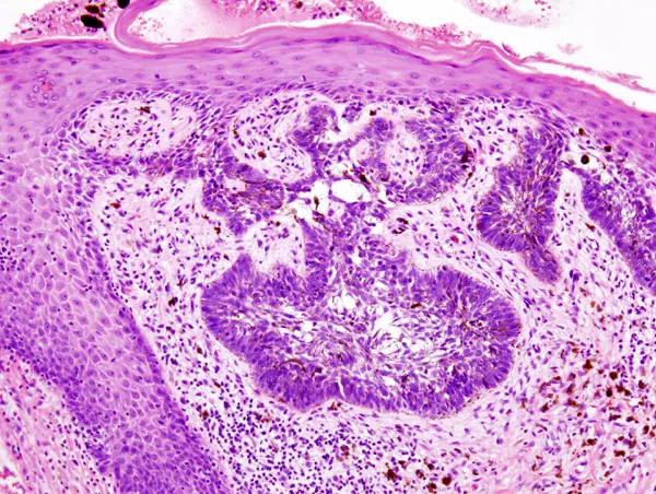 Histopathology of basal cell carcinoma of the skin