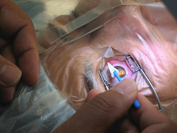 Cataract Surgery: See the World Clearly Again