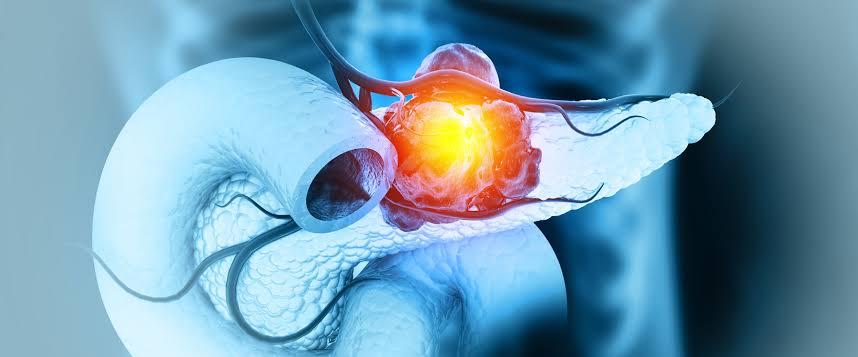 They Don’t Want You to Know About This Breakthrough in Pancreatic Cancer Treatment