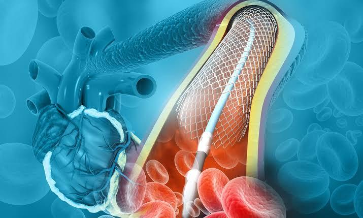 Mastering Stents: A Comprehensive Guide to Types, Placement, and Medical Applications